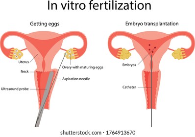 Vector illustration of embryo planting. In vitro fertilization. Getting eggs. 