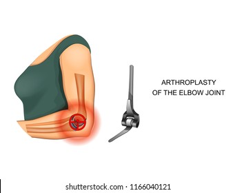 vector illustration of the endoprosthesis of the elbow joint
