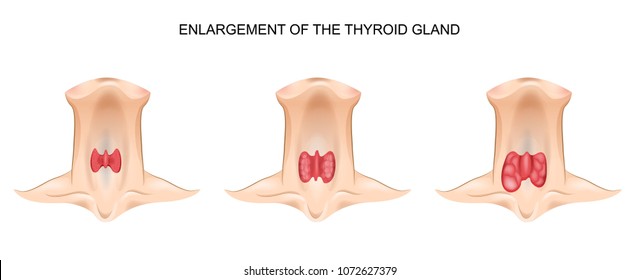 vector illustration of an enlarged thyroid gland