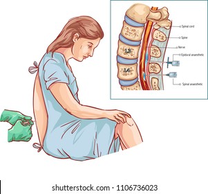  Vector illustration of a Epidural Nerve Block Injection