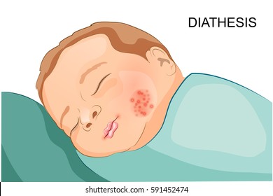 vector illustration of exudative diathesis in toddler