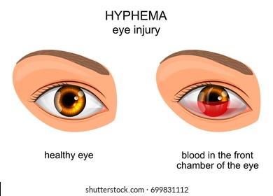 vector illustration of eye injury of the eye. hyphema.