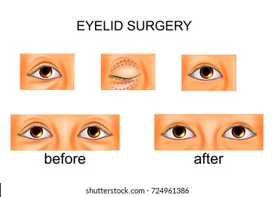 vector illustration of eyelid surgery, plastic surgery