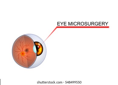 vector illustration of eyes. microsurgery in ophthalmology. for medical publications.