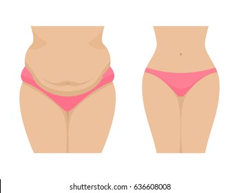 Vector illustration of a fat and thin female belly. Isolated white background. Human abdomen before and after losing weight. Flat style.