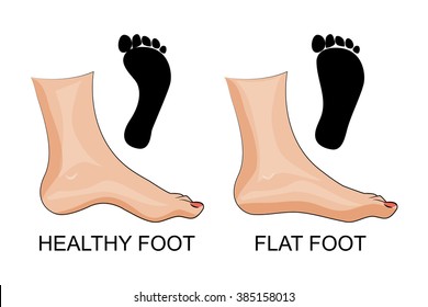 Vector illustration of the feet healthy and flat feet. footprint