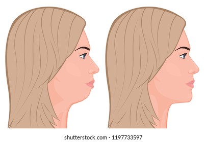 Vector illustration. A female face before, after plastic surgery - chin augmentation. Close up view. For advertising of plastic surgery, medical and beauty publications. EPS 10.