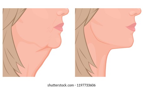 Vector illustration. A female face before, after plastic surgery - facial rejuvenation, face lift. Close up view. For advertising of cosmetological procedures, medical and beauty publications. EPS 10.