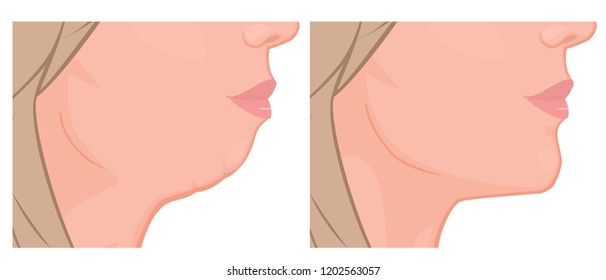 Vector illustration. A female face before, after plastic surgery - chin augmentation. Close up view. For advertising of plastic surgery, medical and beauty publications. EPS 10.
