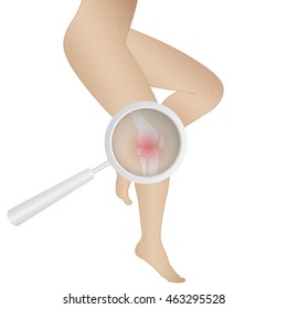 Vector illustration of female legs. The bone disease is arthritis.
