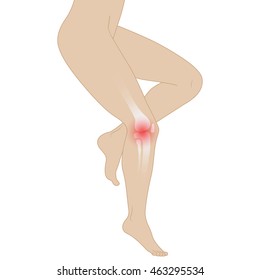 Vector illustration of female legs. The bone disease is arthritis.