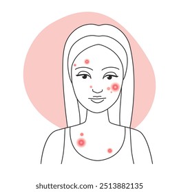 Ilustração vetorial de um retrato feminino com acne e um fundo rosa claro.