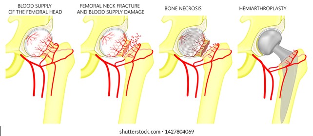 Vector illustration of femoral head blood supply, femoral neck fracture and blood vessels problem, femoral head necrosis and hemiarthroplasty of the hip. For advertising and medical publications.
