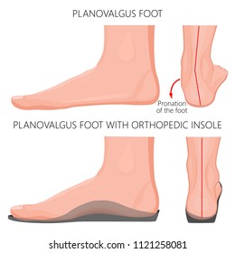 Vector illustration of Flat or planovalgus foot  without and with orthopedic insole. Side (medial) and back views. For advertising and medical publications. EPS 10.