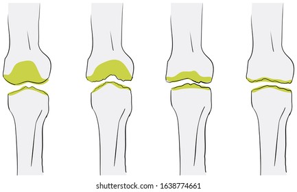 Vector illustration of the flow of osteoarthritis of the knee is worse