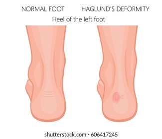 Haglund S Deformity High Res Stock Images Shutterstock