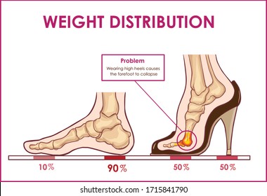  Vector illustration of  foot pain and weight distribution by wearing high heels