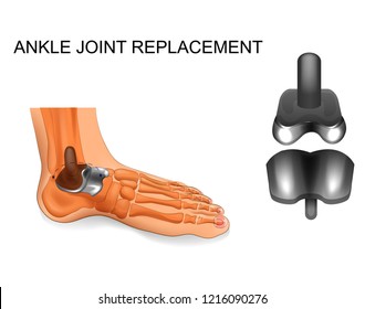 vector illustration of foot skeleton. ankle replacement