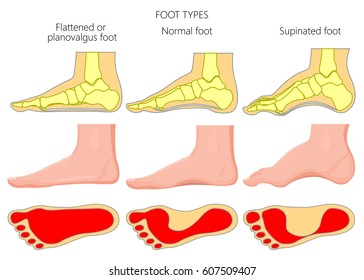 Vector illustration of the foot types. External and skeletal views of medial side of an ankle with footprint. EPS 10.