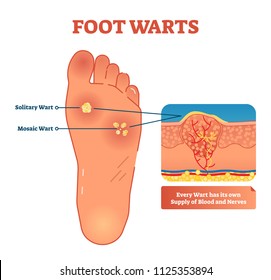 Vector illustration of foot warts. Medical scheme with both types - solitary and mosaic warts. Close-up cross section with detailed wart and its own supply of blood and nerves.