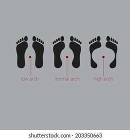 vector illustration of footprints with different archs. Silhouette of foots deformation types. High, normal, low longitudinal and transversal arches. Flat foot inverts or rolls inward.