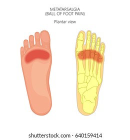 Vector illustration of forefoot pain, metatarsalgia symptom, tenderness in the balls of metatarsal bones of the foot. For advertising and other medical publications. EPS 10.