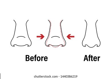 Vector illustration. Front view of a wide human nose before, after aesthetic plastic surgery - rhinoplasty nose job . Close up view. For advertising, medical and beauty publications. EPS 10.