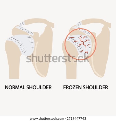 Vector illustration of frozen shoulder showing stiffness, pain, limited arm movement, and reduced range of motion, with related conditions like rotator cuff disorder, bursitis, and arthritis.icon