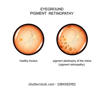 vector illustration of the fundus. pigment retinopathy