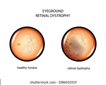 vector illustration of the fundus. retinal dystrophy