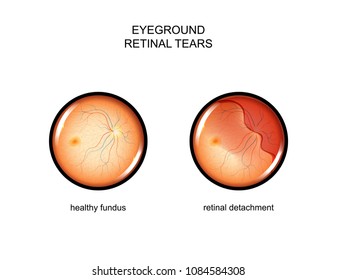vector illustration of the fundus. retinal tears