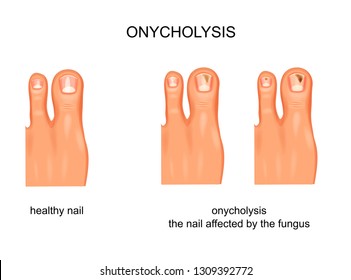 vector illustration of fungal nail infection, onycholysis