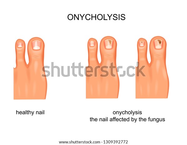 Vector Illustration Fungal Nail Infection Onycholysis Stock Vector ...