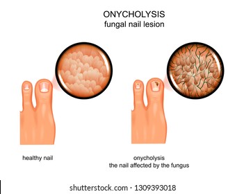 vector illustration of fungal nail lesion. infection, onycholysis