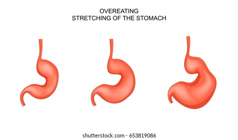 vector illustration of gastric banding, stretched from overeating
