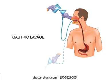 Vector Illustration Of Gastric Lavage With A Gastric Tube