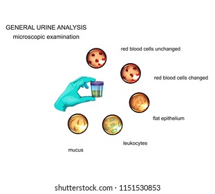 vector illustration of the General analysis of urine. microscopy