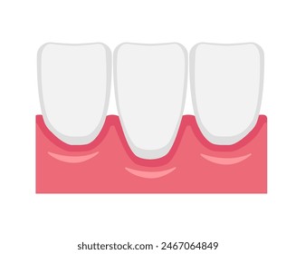 Vector illustration of gingival recession