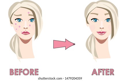 Vector Illustration Girl Face Without Acne Stock Vector (royalty Free 