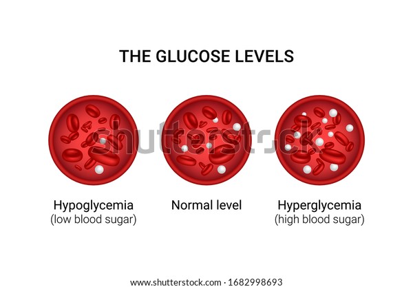 Vector illustration of glucose levels in\
the blood. Hypoglycemia.\
Hyperglycemia.