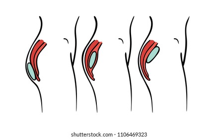 Vector illustration of gluteal plastic surgery types - buttocks implants positions chart: submuscular, intramuscular and subcutaneous implantation.