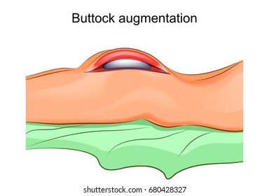 vector illustration of a gluteoplasty. plastic surgery