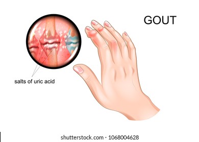 vector illustration of gout, arthritis of fingers