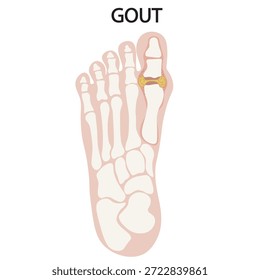 Ilustración vectorial de gota que muestra inflamación articular, enrojecimiento, hinchazón y dolor intenso, con afecciones relacionadas como artritis, seudogota y trastornos reumatoideos