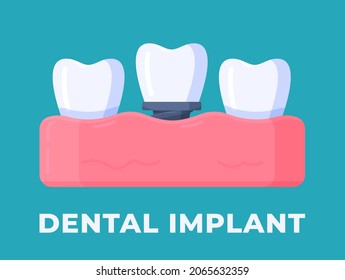 Vector illustration of gum disease isolated on a blue background. Modern dentistry.