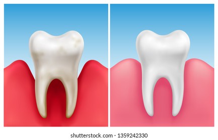 Vector illustration of gum disease -  periodontitis in compare with healthy white tooth