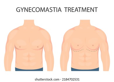 Ilustración vectorial de la ginecomastia en hombres antes y después del tratamiento. El pecho humano en media vuelta (vista frontal y lateral). Para la publicidad de procedimientos plásticos cosméticos