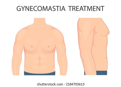 Vector illustration of gynecomastia in men before and after treatment. Human chest in a half-turn (front and side view). For advertising cosmetic plastic procedures