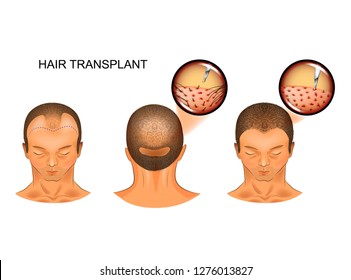 48 Hair loss falling on back Images, Stock Photos & Vectors | Shutterstock