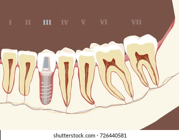 Vector illustration - half of mandible with tooth implant - cross section